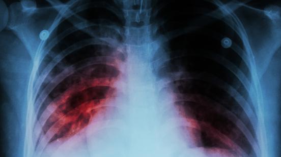 tuberculosis Foto: Internet