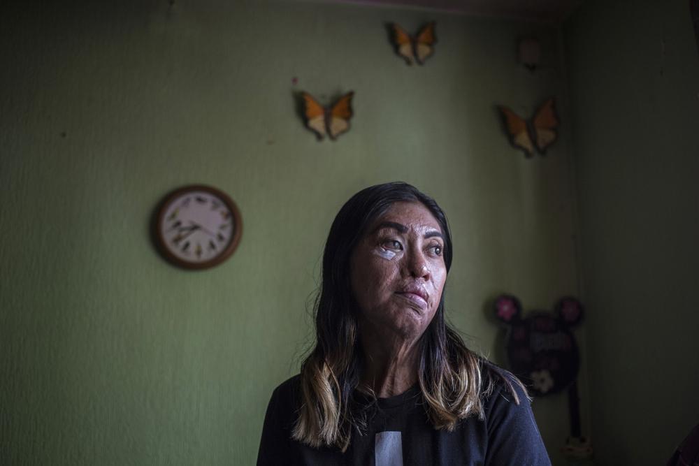 Supervivientes de ataques con ácido en México unen fuerzas