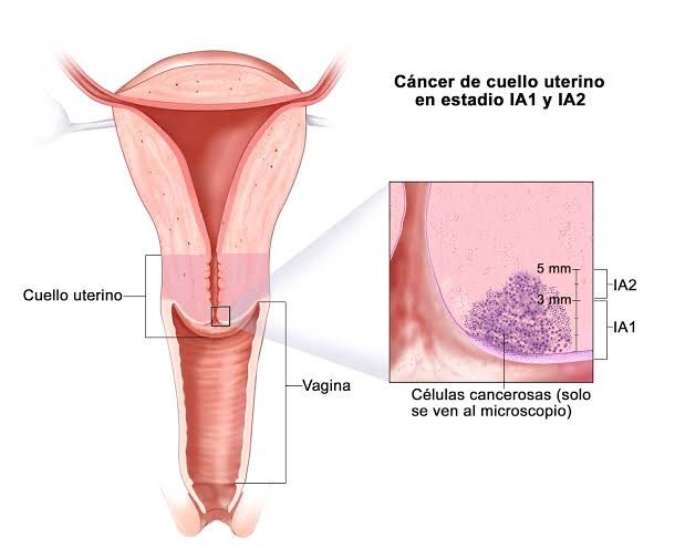 cáncer de cuello uterino Foto: @ISSSTE_mx
