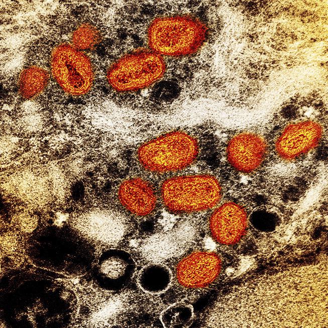 ¿La viruela símica es una enfermedad de transmisión sexual? Foto: AP