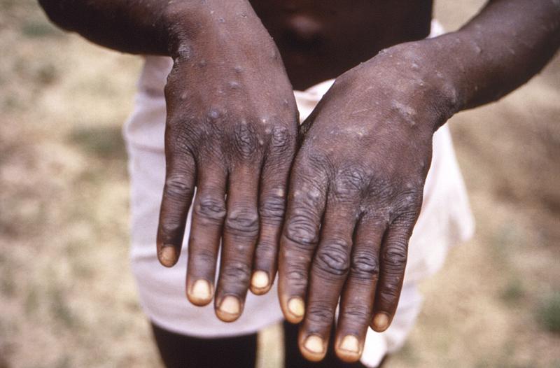 África dice tratar brote de viruela símica como emergencia Foto: AP